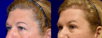 Left 3/4 View - Browlift and Upper Eyelid Surgery