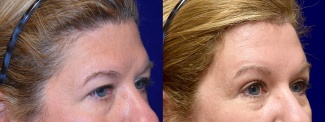 Right 3/4 View - Browlift and Upper Eyelid Surgery