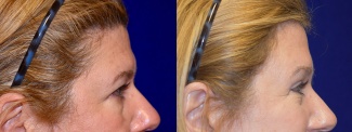 Right Profile View - Browlift and Upper Eyelid Surgery