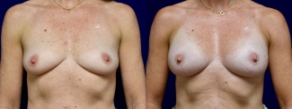 Frontal View - Breast Augmentation