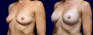 Left 3/4 View - Breast Augmentation