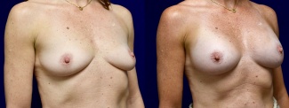 Right 3/4 View - Breast Augmentation