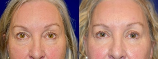 Frontal View - Eyelid Surgery