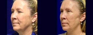 Left 3/4 View - Facelift, Browlift, Upper Eyelid Surgery