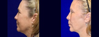 Left Profile View - Facelift, Browlift, Upper Eyelid Surgery