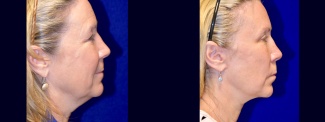 Right Profile View - Facelift, Browlift, Upper Eyelid Surgery