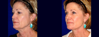 Left 3/4 View - Lower Facelift and Upper Eyelid Surgery