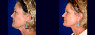 Left Profile View - Lower Facelift and Upper Eyelid Surgery
