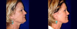 Right Profile View - Lower Facelift and Upper Eyelid Surgery