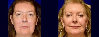 Frontal View - Lower Facelift