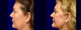 Left Profile View - Lower Facelift