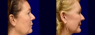Right Profile View - Lower Facelift