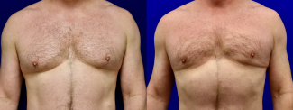Frontal View - Male Breast Reducion