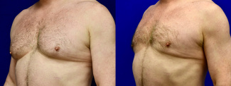 Left 3/4 View - Male Breast Reducion
