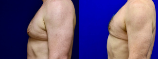 Left Profile View - Male Breast Reducion