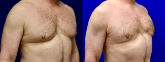 Right 3/4 View - Male Breast Reducion