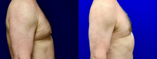 Right Profile View - Male Breast Reducion