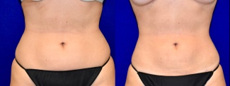 Frontal View -Liposuction