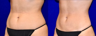 Left 3/4 View -Liposuction