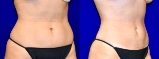 Right 3/4 View -Liposuction