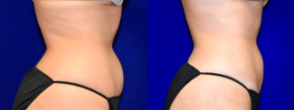Right Profile View -Liposuction