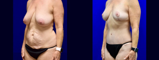 Left 3/4 View - Mommy Makeover Breast Lift and Tummy Tuck