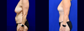 Left Profile View - Mommy Makeover Breast Lift and Tummy Tuck