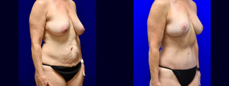 Right 3/4 View - Mommy Makeover Breast Lift and Tummy Tuck