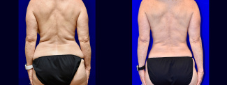 Back View Mommy Makeover Breast Lift and Tummy Tuck