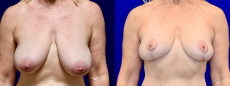 Frontal View - Mommy Makeover Breast Lift