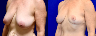 Left 3/4 View - Mommy Makeover Breast Lift