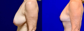 Left Profile View - Mommy Makeover Breast Lift