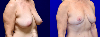 Right 3/4 View - Mommy Makeover Breast Lift