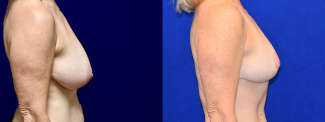 Right Profile View - Mommy Makeover Breast Lift