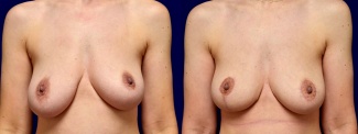 Frontal View - Breast Lift