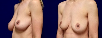 Left 3/4 View - Breast Lift