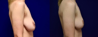 Right Profile View - Breast Lift