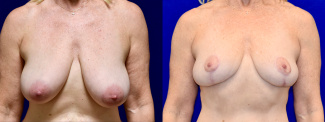 Frontal View - Breast Lift