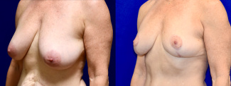 Left 3/4 View - Breast Lift