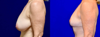 Left Profile View - Breast Lift