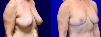 Right 3/4 View - Breast Lift