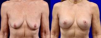 Frontal View - Breast Augmentation with Lift