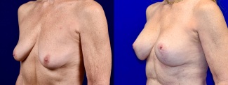 Left 3/4 View - Breast Augmentation with Lift