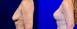 Left Profile View - Breast Augmentation with Lift