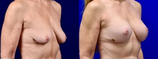 Right 3/4 View - Breast Augmentation with Lift