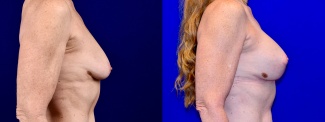 Right Profile View - Breast Augmentation with Lift