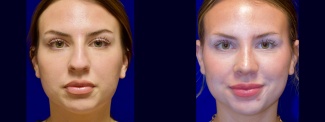 Frontal View - Rhinoplasty