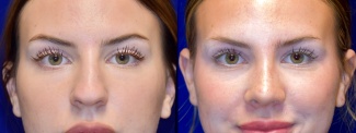 Frontal View - Rhinoplasty 