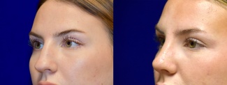 Left 3/4 View - Rhinoplasty 