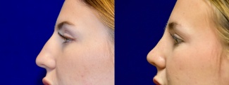 Left Profile View - Rhinoplasty 